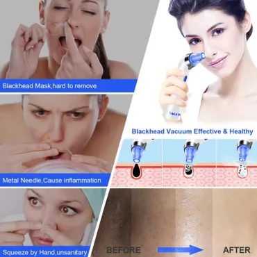 Машинка за почистване на черни точки, вакуум уред за лице - FacialMachine