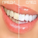 Pisalka-za-izbelvane-na-zbi-Teeth-Whitening-Pen-03-17-05-Teeth-Whitening-Pen